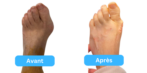 Chirurgien de l'hallux valgus à Nice 75000 - Dr Eddy Becquet